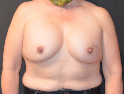 Breast Implant Reconstruction Before & After Gallery - Patient 370511 - Image 1