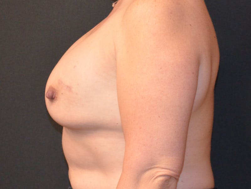 Breast Implant Reconstruction Before & After Gallery - Patient 370511 - Image 5