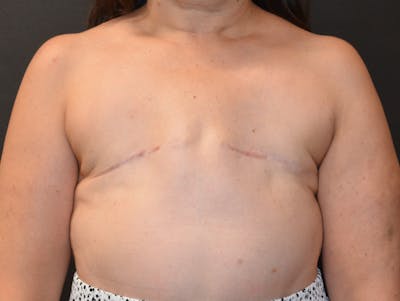 Breast Flap Reconstruction Before & After Gallery - Patient 129508 - Image 1
