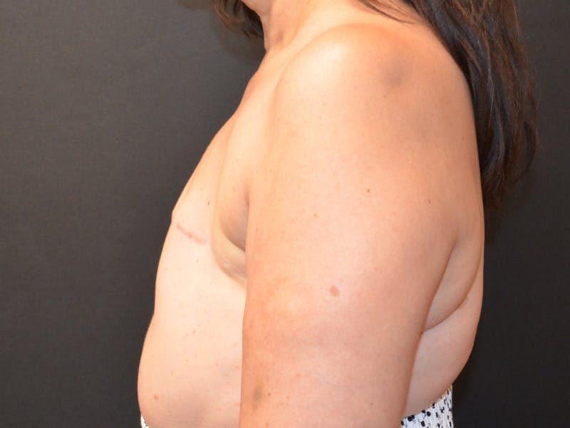 Breast Flap Reconstruction Before & After Gallery - Patient 129508 - Image 5