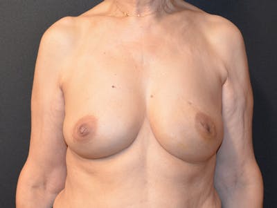 Breast Implant Reconstruction Before & After Gallery - Patient 334260 - Image 1