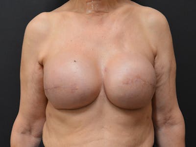 Breast Implant Reconstruction Before & After Gallery - Patient 334260 - Image 2