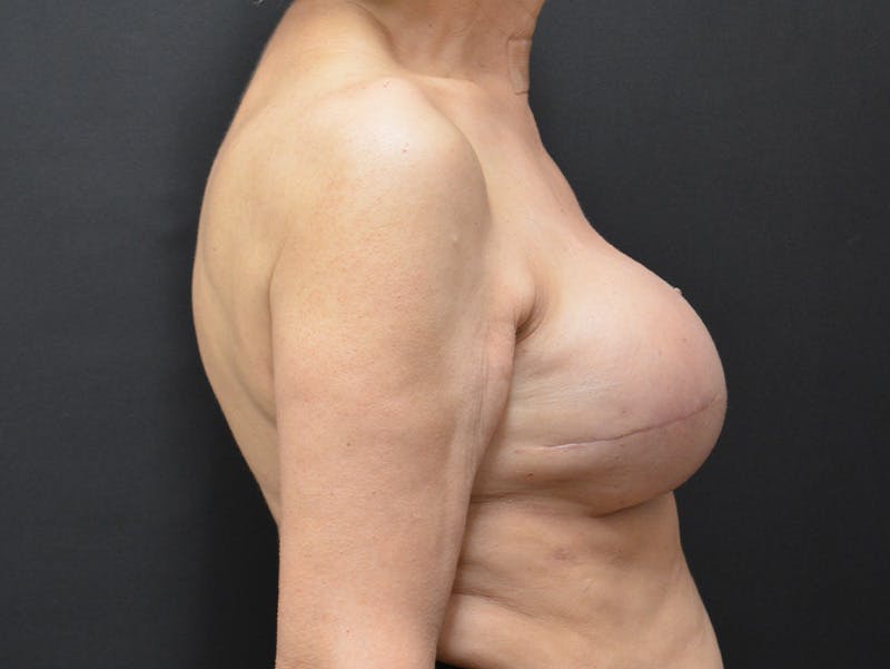 Breast Implant Reconstruction Before & After Gallery - Patient 334260 - Image 4