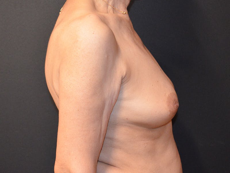 Breast Implant Reconstruction Before & After Gallery - Patient 334260 - Image 3