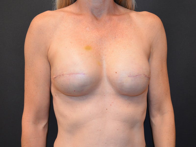 Breast Implant Reconstruction Before & After Gallery - Patient 410418 - Image 2