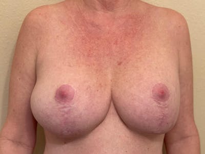 En Bloc Capsulectomy Before & After Gallery - Patient 389482 - Image 1