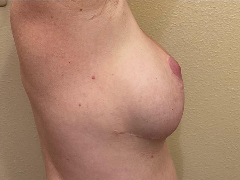Breast Lift Before & After Gallery - Patient 196449 - Image 3