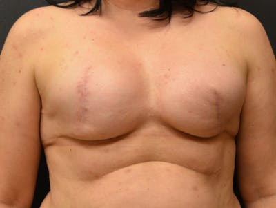 Breast Implant Reconstruction Before & After Gallery - Patient 345354 - Image 1