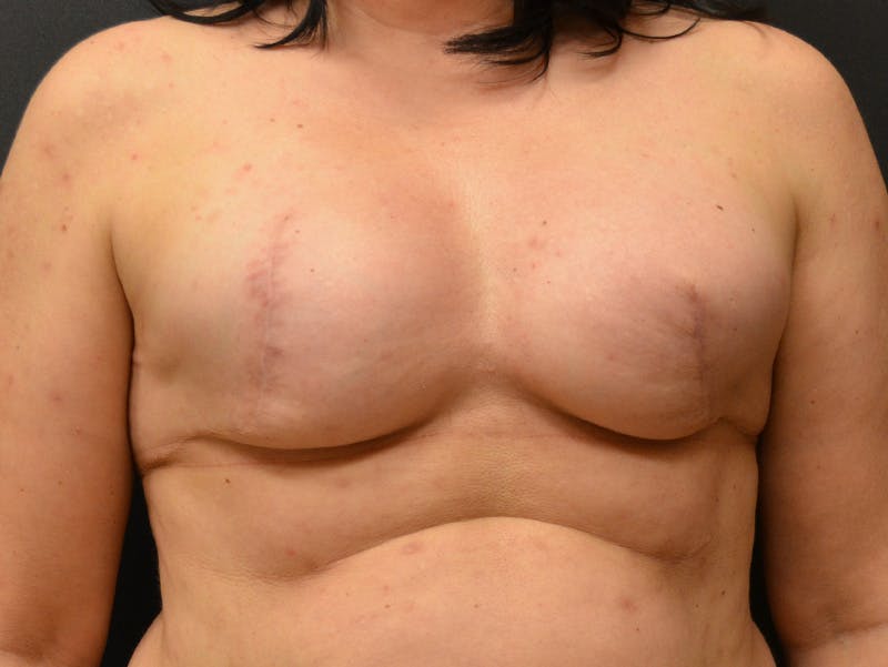 Breast Implant Reconstruction Before & After Gallery - Patient 345354 - Image 1