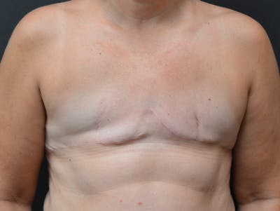 Breast Implant Reconstruction Before & After Gallery - Patient 345354 - Image 2