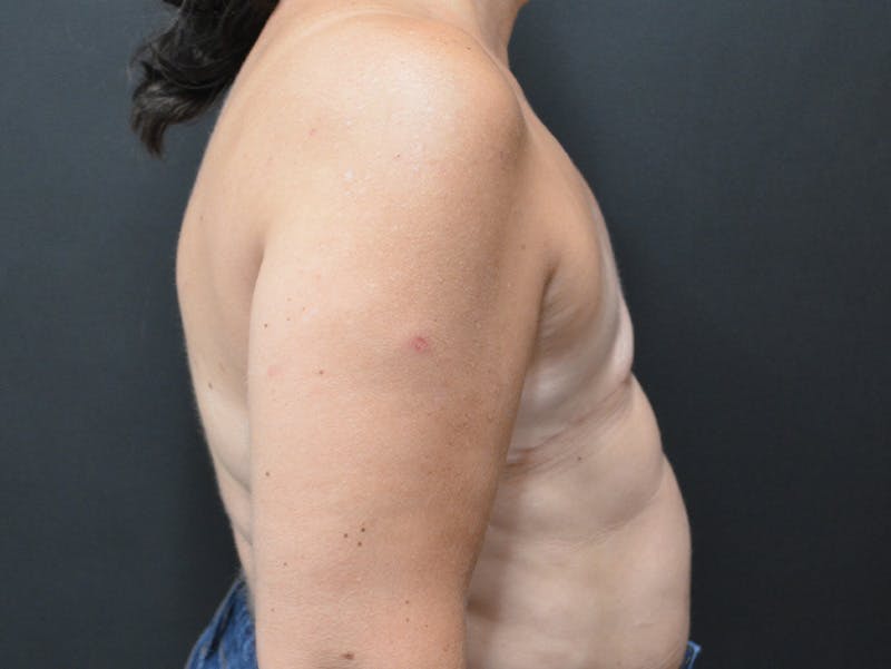 Breast Implant Reconstruction Before & After Gallery - Patient 345354 - Image 6