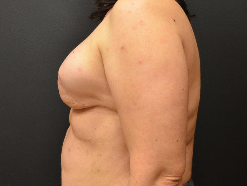 Breast Implant Reconstruction Before & After Gallery - Patient 345354 - Image 3
