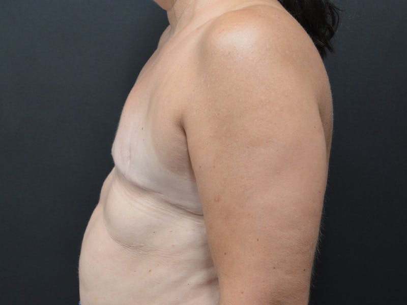 Breast Implant Reconstruction Before & After Gallery - Patient 345354 - Image 4
