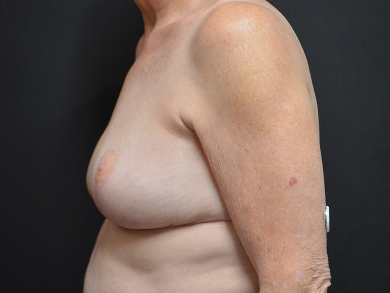Breast Reduction Before & After Gallery - Patient 390738 - Image 6
