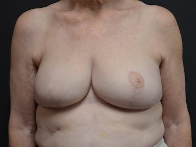 Breast Implant Reconstruction Before & After Gallery - Patient 578045 - Image 2