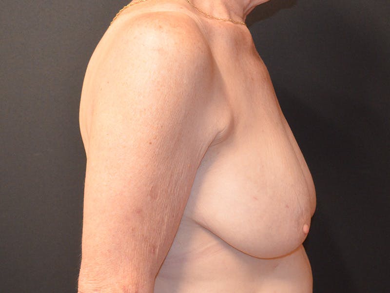Breast Reduction Before & After Gallery - Patient 390738 - Image 3