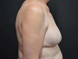 Breast Reduction Before & After Gallery - Patient 390738 - Image 4