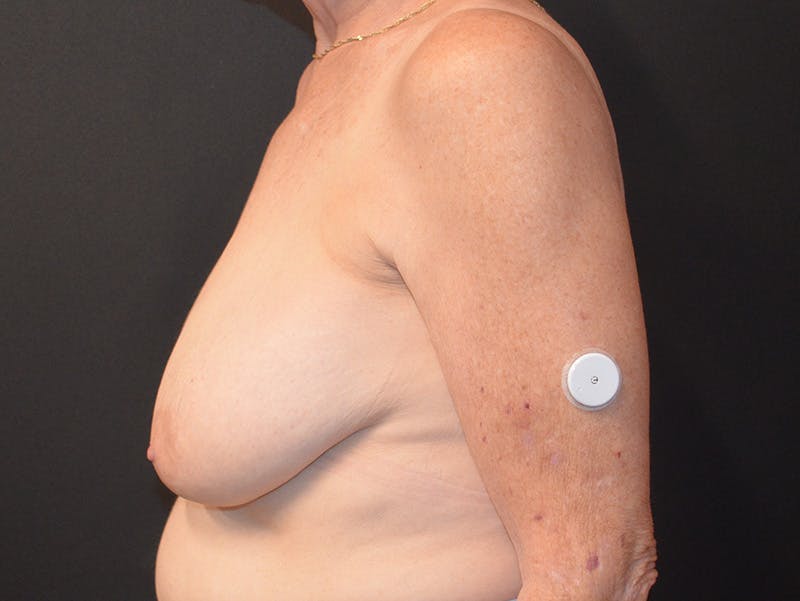 Breast Reduction Before & After Gallery - Patient 390738 - Image 5