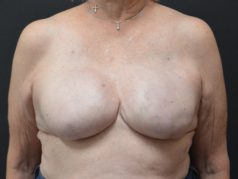 Breast Implant Reconstruction Before & After Gallery - Patient 753242 - Image 2