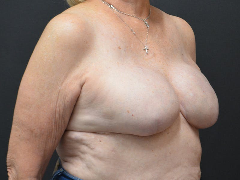 Breast Implant Reconstruction Before & After Gallery - Patient 753242 - Image 4