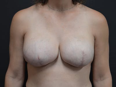 Breast Asymmetry Correction Before & After Gallery - Patient 536606 - Image 2