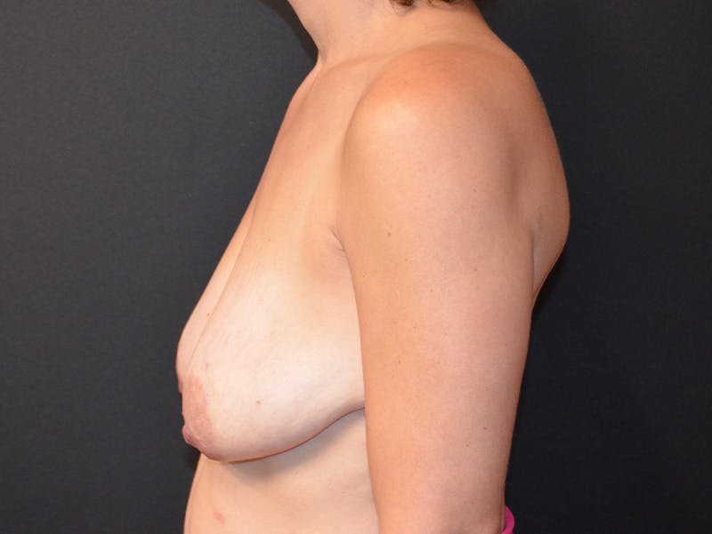 Breast Asymmetry Correction Before & After Gallery - Patient 536606 - Image 5