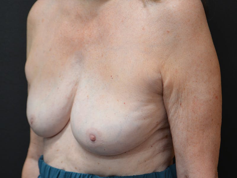 En Bloc Capsulectomy Before & After Gallery - Patient 411766 - Image 5