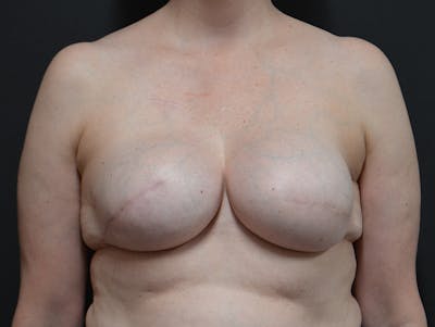 Breast Reconstruction Before & After Gallery - Patient 225190 - Image 2