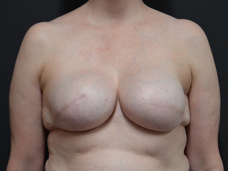 Breast Reconstruction Before & After Gallery - Patient 225190 - Image 2