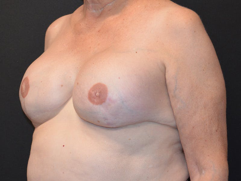 Breast Reconstruction Before & After Gallery - Patient 158260 - Image 4