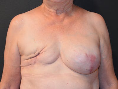 Breast Reconstruction Before & After Gallery - Patient 158260 - Image 1