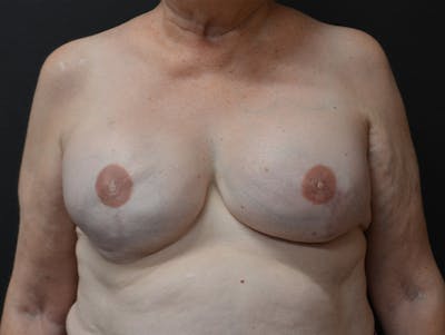 Breast Reconstruction Before & After Gallery - Patient 158260 - Image 2