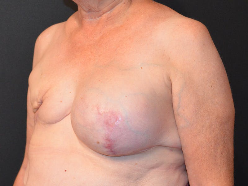 Breast Reconstruction Before & After Gallery - Patient 158260 - Image 3