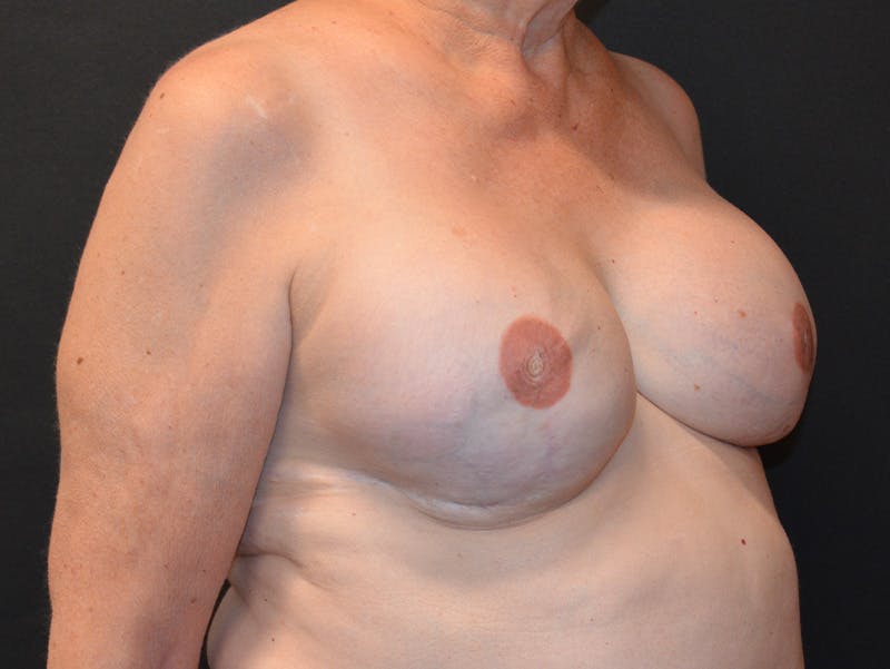 Breast Reconstruction Before & After Gallery - Patient 158260 - Image 6
