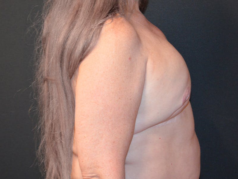 Breast Reconstruction Before & After Gallery - Patient 379061 - Image 3