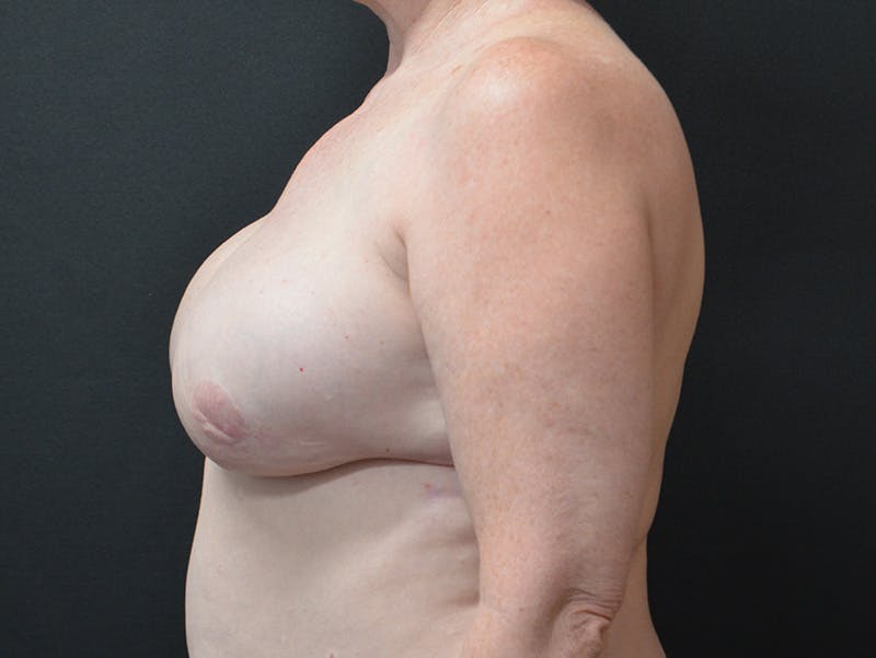 Breast Reconstruction Before & After Gallery - Patient 379061 - Image 6