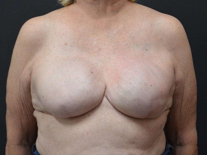 Breast Reconstruction Before & After Gallery - Patient 227373 - Image 2