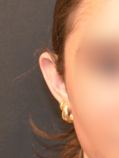 Otoplasty Before & After Gallery - Patient 408431 - Image 1