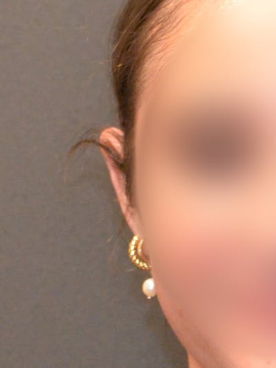 Otoplasty Before & After Gallery - Patient 408431 - Image 2