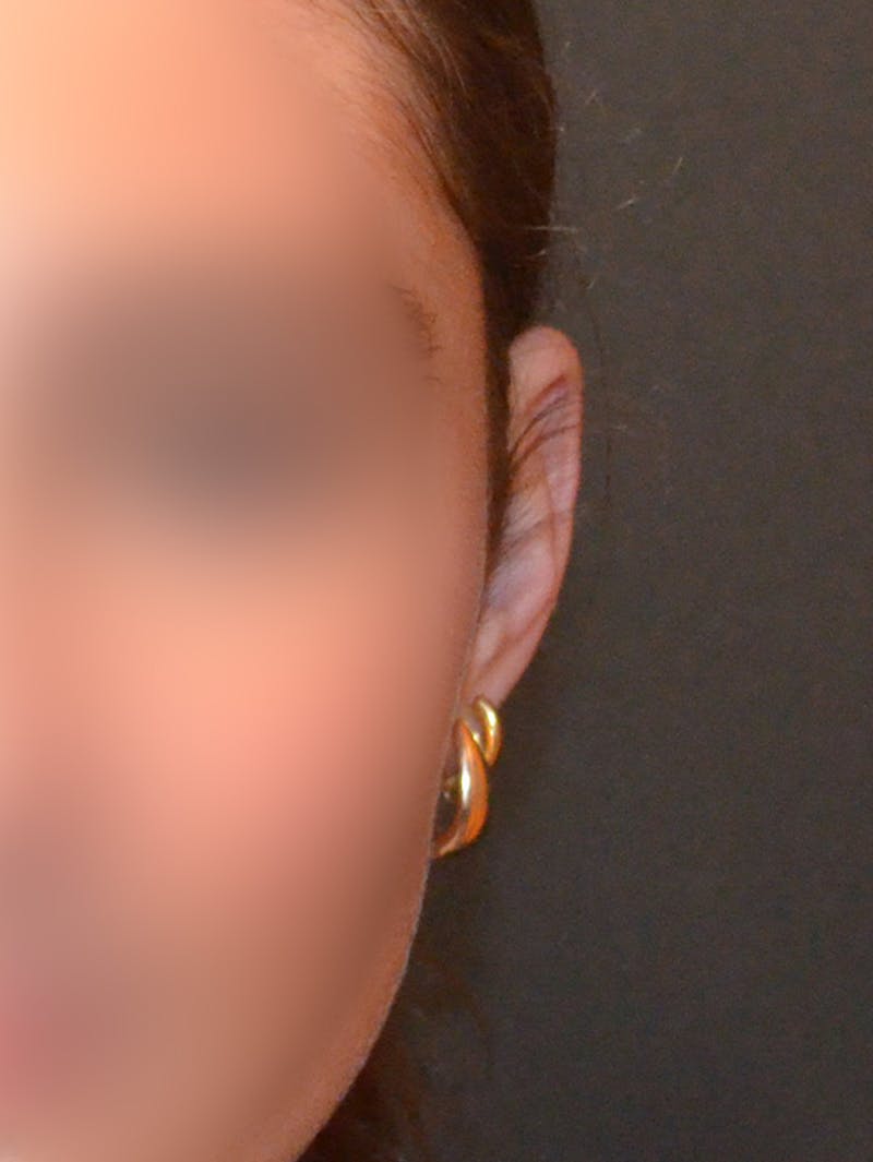 Otoplasty Before & After Gallery - Patient 408431 - Image 3