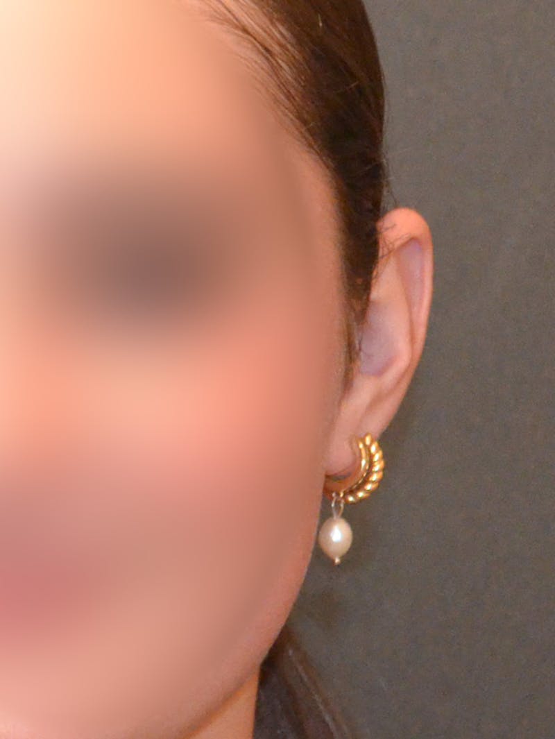 Otoplasty Before & After Gallery - Patient 408431 - Image 4