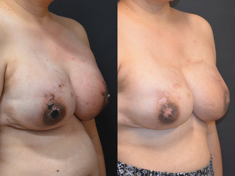 Breast Implant Reconstruction Before & After Gallery - Patient 349417 - Image 4