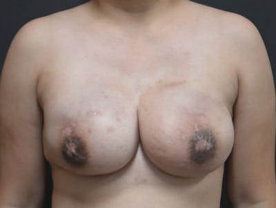 Breast Implant Reconstruction Before & After Gallery - Patient 349417 - Image 2
