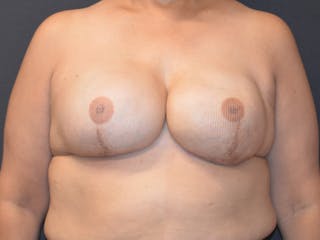 Reconstruction Tattoo Before & After Gallery - Patient 243632 - Image 2