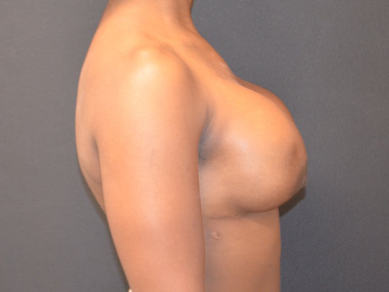 Breast Implant Reconstruction Before & After Gallery - Patient 138927 - Image 4
