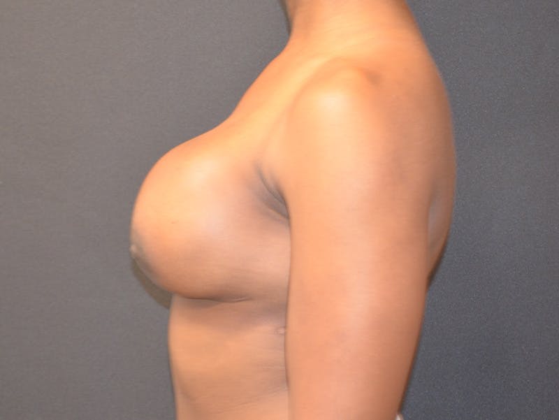 Breast Implant Reconstruction Before & After Gallery - Patient 138927 - Image 6