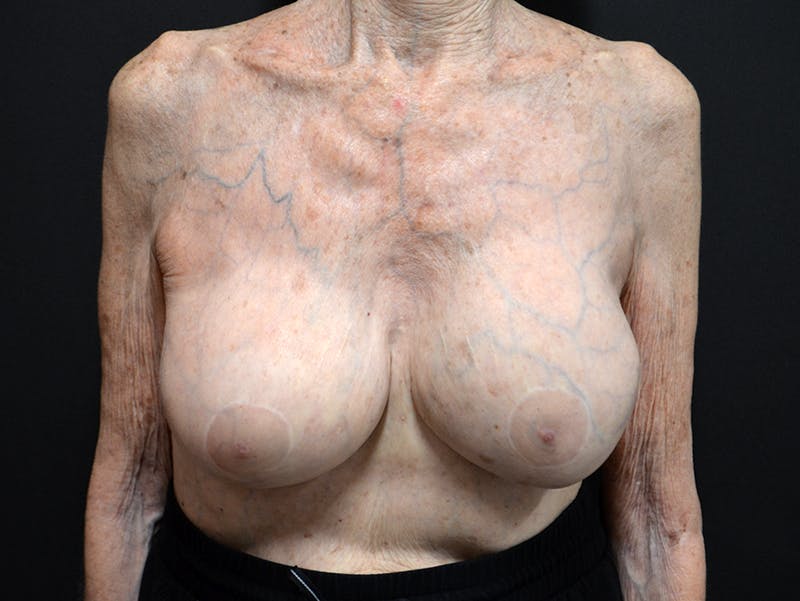 Breast Revision Before & After Gallery - Patient 212915 - Image 2