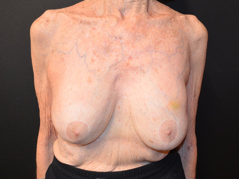 Breast Revision Before & After Gallery - Patient 212915 - Image 1