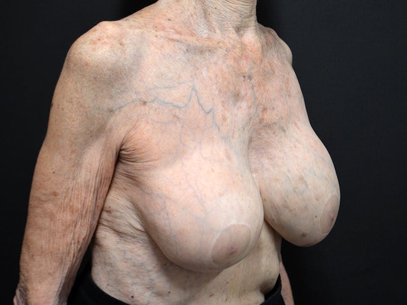 Breast Revision Before & After Gallery - Patient 212915 - Image 4