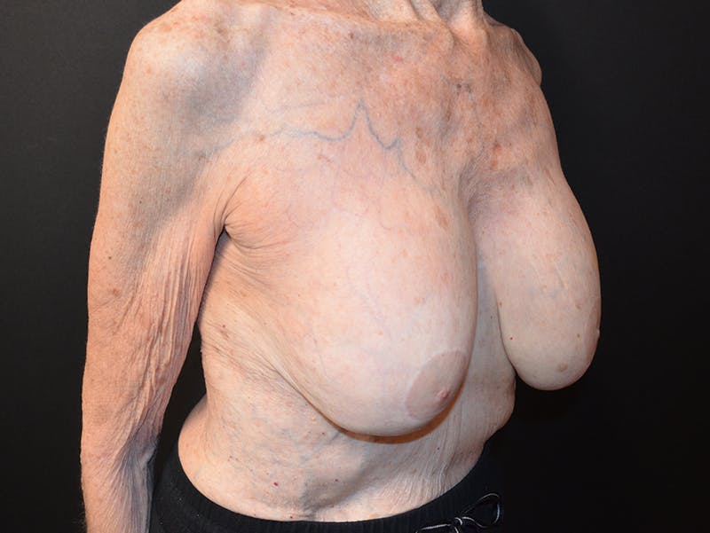 Breast Revision Before & After Gallery - Patient 212915 - Image 3